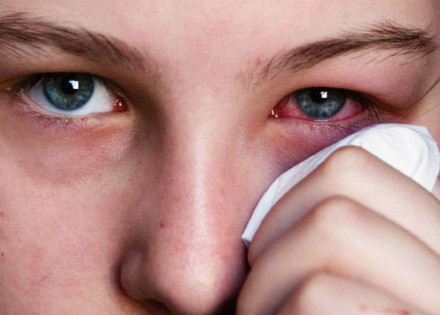 saiba-como-se-prevenir-de-conjuntivite-no-verao-correio-nogueirense