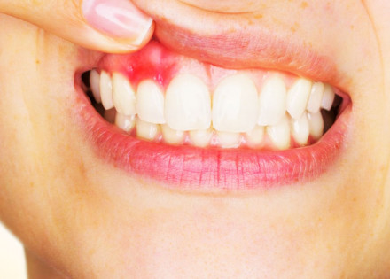 cuidados-com-a-gengiva-e-fundamental-correio-nogueirense