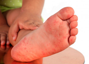 surto-da-doenca-mao-pe-boca-correio-nogueirense