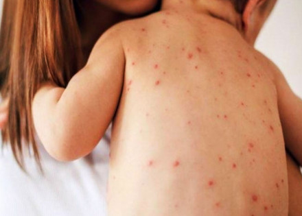 ministerio-da-saude-divulga-atualizacao-de-casos-de-sarampo-no-brasil-correio-nogueirense