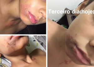 garoto-queima-o-corpo-apos-salgado-frito-estourar-correio-nogueirense