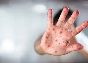 novo-caso-de-sarampo-e-confirmado-para-indaiatuba-em-mulher-de-28-anos-correio-nogueirense