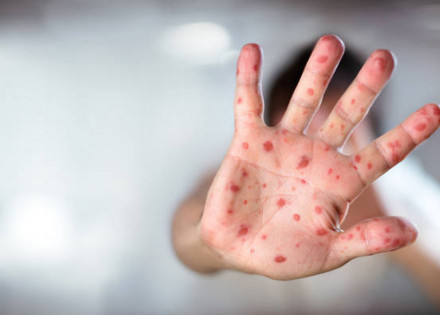 novo-caso-de-sarampo-e-confirmado-para-indaiatuba-em-mulher-de-28-anos-correio-nogueirense