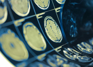 lembrado-hoje-dia-mundial-do-avc-serve-de-alerta-a-populacao-correio-nogueirense