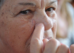 pandemia-impede-diagnostico-precoce-de-cancer-de-pele-correio-nogueirense