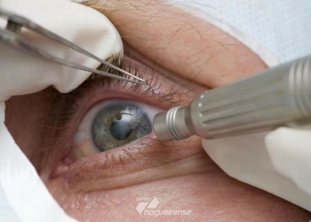 pandemia-faz-cair-deteccao-precoce-de-glaucoma-correio-nogueirense