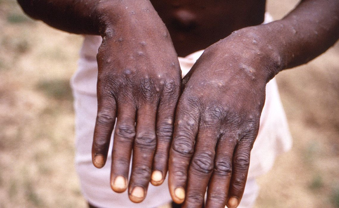 2022-05-18t225151z_1_lynxnpei4h16e_rtroptp_4_health-monkeypox-1