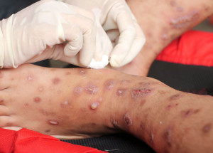 variola-dos-macacos-entenda-a-transmissao-os-sintomas-e-a-vacina-correio-nogueirense