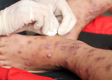 variola-dos-macacos-entenda-a-transmissao-os-sintomas-e-a-vacina-correio-nogueirense