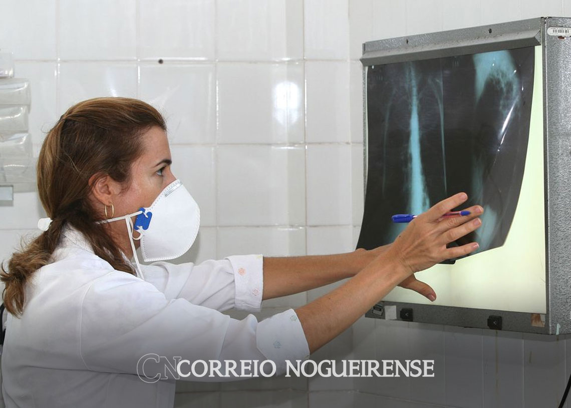 brasil-registra-78-mil-novos-casos-de-tuberculose-correio-nogueirense