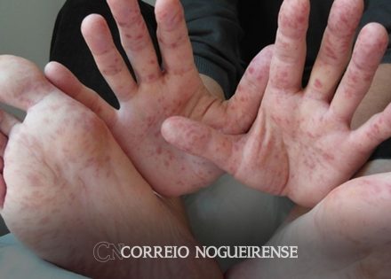 casos-da-doenca-mao-pe-boca-cresceram-149-no-estado-de-sp-em-2023-correio-nogueirense