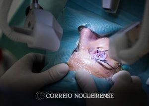 medicos-alertam-para-riscos-de-cirurgia-de-mudanca-da-cor-dos-olhos-correio-nogueirense