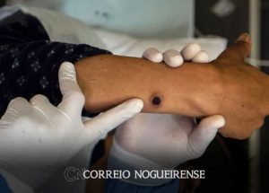 casos-de-mpox-no-brasil-este-ano-ja-superam-o-total-de-2023-correio-nogueirense
