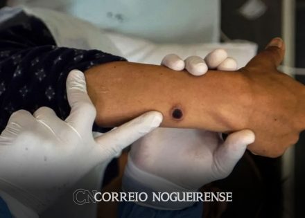 casos-de-mpox-no-brasil-este-ano-ja-superam-o-total-de-2023-correio-nogueirense