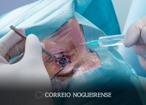 fila-para-transplantes-de-cornea-no-pais-quase-triplica-em-uma-decada-correio-nogueirense