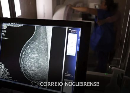cerca-de-77-mil-mulheres-aguardam-mamografia-pelo-sus-correio-nogueirense