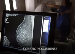 periodicidade-de-mamografias-divide-medicos-e-autoridades-de-saude-correio-nogueirense