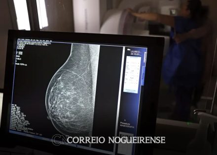periodicidade-de-mamografias-divide-medicos-e-autoridades-de-saude-correio-nogueirense