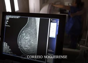 cancer-de-mama-uma-em-cada-tres-pacientes-tem-menos-de-50-anos-correio-nogueirense